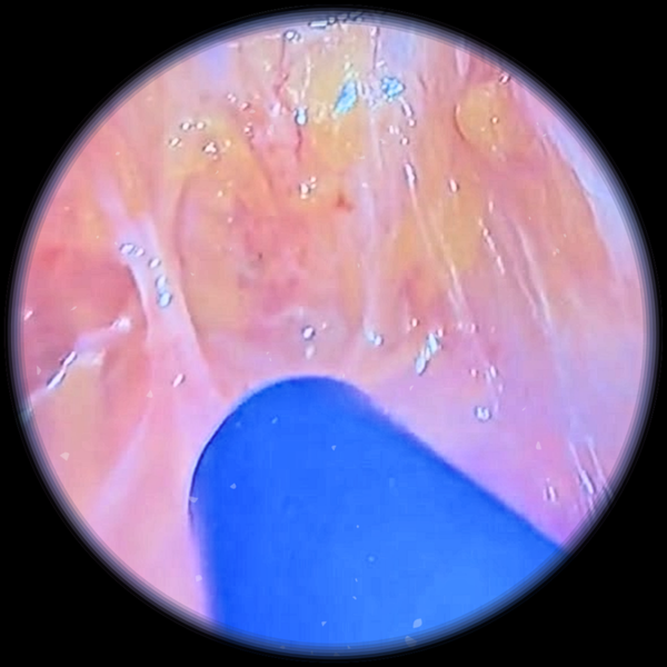 Beyond the Surface: Introducing Depth to Surgical Visualization with AED ENDOPRO® 3D